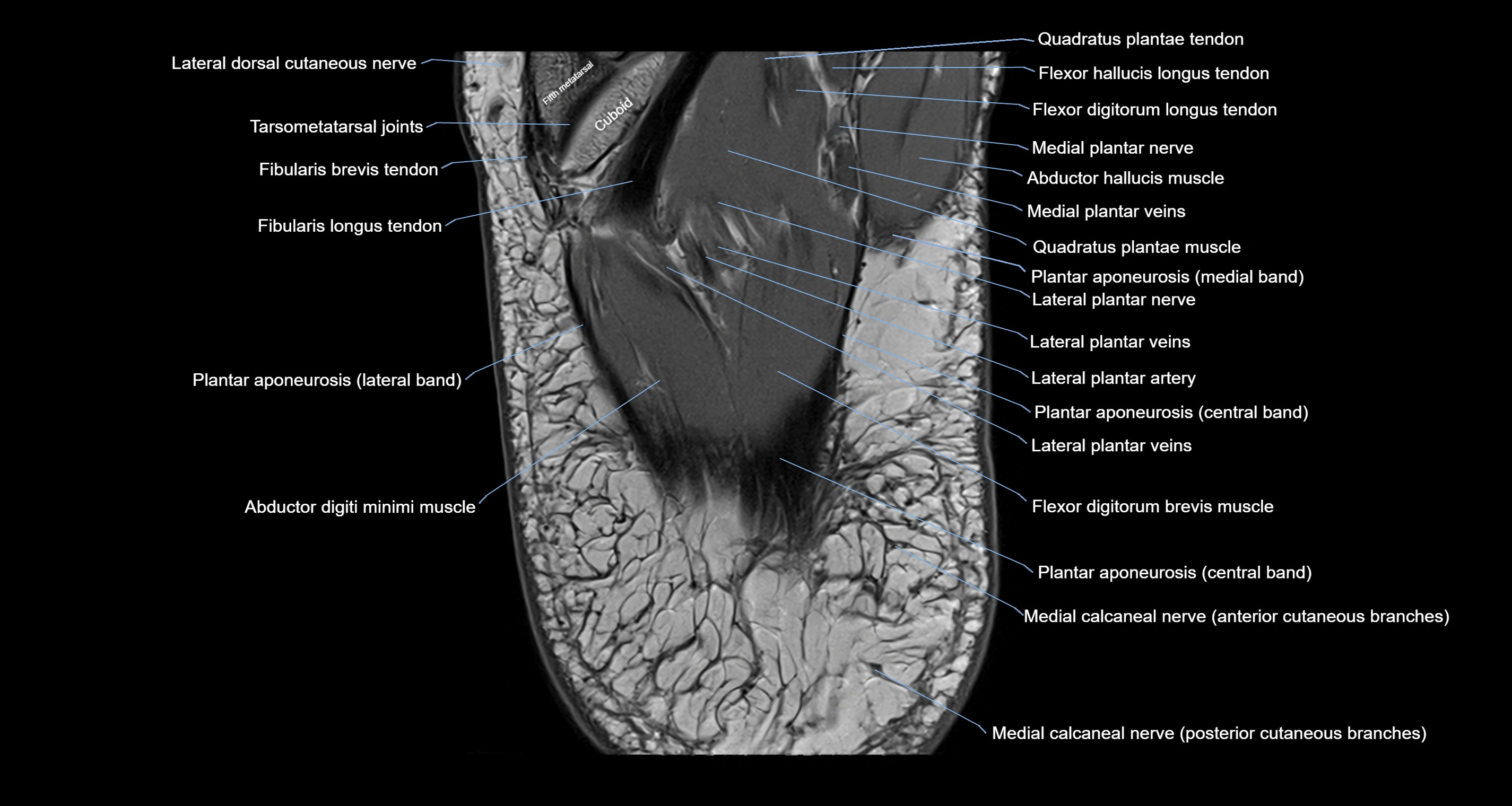 Ankle axial anatomy 3T MRI images -img-10001-00039.webp